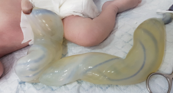 Une Malformation Congenitale Rare Le Cordon Ombilical Geant Pediatrie Pratique Une Malformation Congenitale Rare Le Cordon Ombilical Geant Pediatrie Pratique
