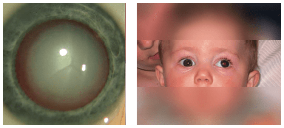 Deux Urgences Rares Chez L Enfant Cataracte Et Glaucome Defis Diagnostiques Et Therapeutiques Pediatrie Pratique Deux Urgences Rares Chez L Enfant Cataracte Et Glaucome Defis Diagnostiques Et Therapeutiques Pediatrie Pratique