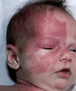Lesions Cutanees De L Enfant Quand La Couleur Oriente Le Diagnostic Pediatrie Pratique