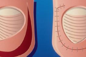 L Ongle Incarne De L Enfant Pediatrie Pratique L Ongle Incarne De L Enfant Pediatrie Pratique