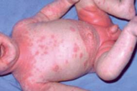 La Dermite Seborrheique Du Neuf En Physiopathologie Et En Therapeutique Pediatrie Pratique La Dermite Seborrheique Du Neuf En Physiopathologie Et En Therapeutique Pediatrie Pratique