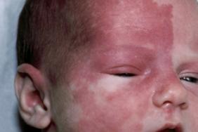 Lesions Cutanees De L Enfant Quand La Couleur Oriente Le Diagnostic Pediatrie Pratique