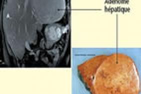 Foie Et Maladies Metaboliques De L Enfant Des Grandes Lignes Pour Comprendre Pediatrie Pratique