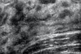 Pathologie Mammaire De L Enfant Et De L Adolescente Pediatrie Pratique Pathologie Mammaire De L Enfant Et De L Adolescente Pediatrie Pratique