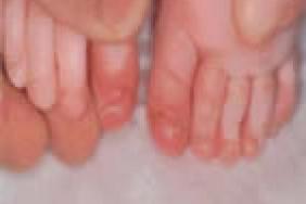 L Ongle De L Enfant Pediatrie Pratique