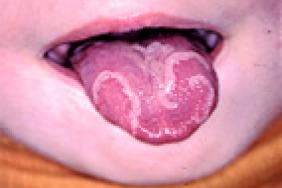 Le Diagnostic Au Bout De La Langue Principales Pathologies De La Muqueuse Buccale De L Enfant Pediatrie Pratique Le Diagnostic Au Bout De La Langue Principales Pathologies De La Muqueuse Buccale De L Enfant Pediatrie Pratique