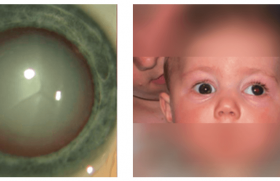 La Rosacee Oculaire Pediatrie Pratique La Rosacee Oculaire Pediatrie Pratique