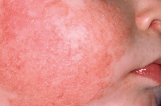 Dermatite atopique de l’enfant : les avancées thérapeutiques