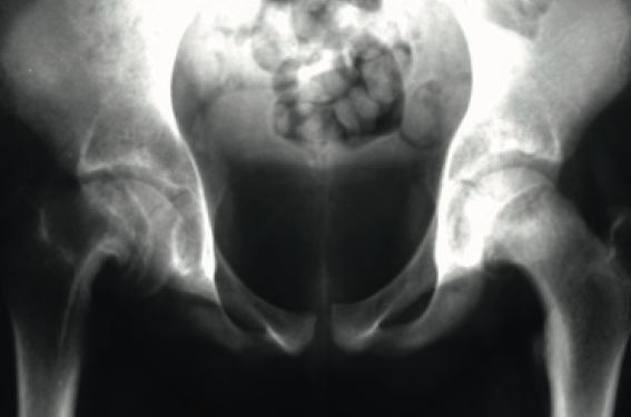 Rhume de hanche : symptômes, causes et traitements - Conseil Santé