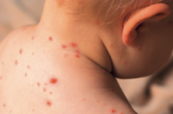 Ces virus que l’on croit connaître : la varicelle