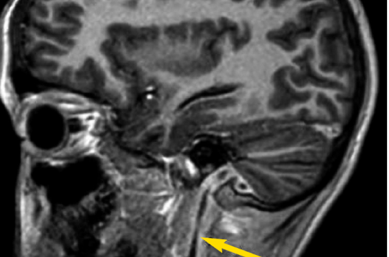 Deux cas cliniques d’infectiologie