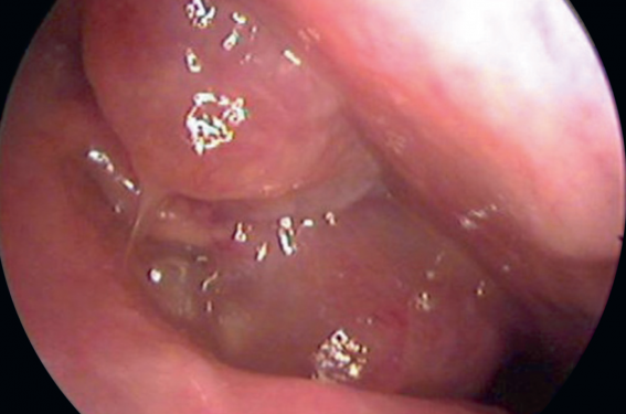 Diagnostic et prise en charge d’une polypose naso-sinusienne chez l’enfant