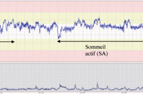 Analyse informatisée du rythme cardiaque fœtal au cours de la grossesse et  de l'accouchement - ScienceDirect