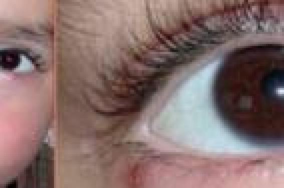 La rosacée oculaire | Pédiatrie Pratique