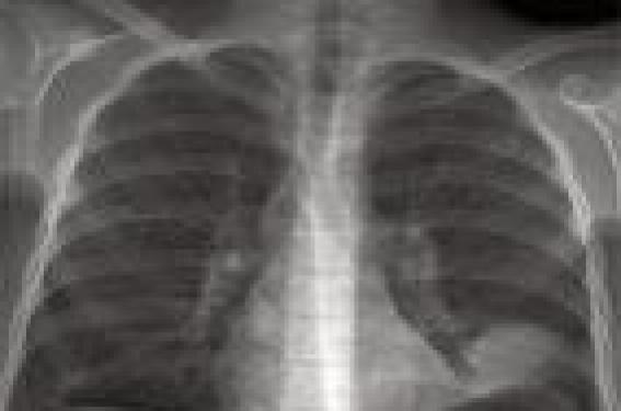 La radiographie thoracique est-elle utile dans les toux chroniques ?